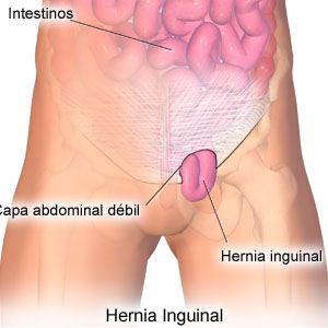 Hernias: natural tips for diet and treatment, prevention and post-operation