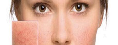 Cuperosis or facial flushing: Causes and Natural Treatment