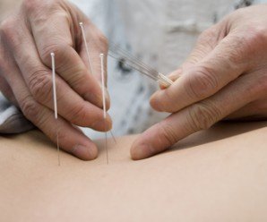 Treatment by acupuncture